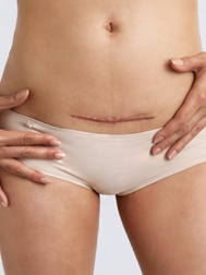C-Section
