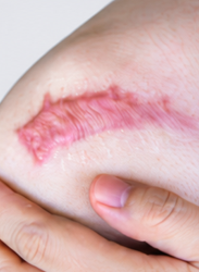Hypertrophic Scars