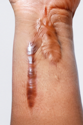Keloid Scars