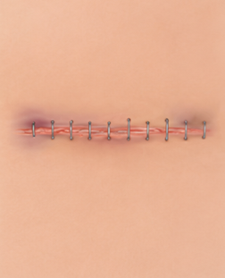 Stitches Not