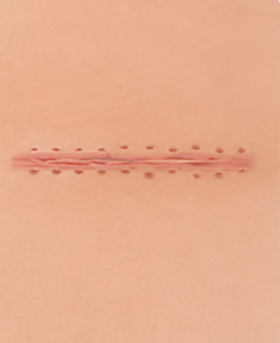 After Stitches