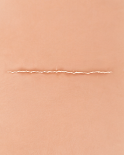 Existing Scars